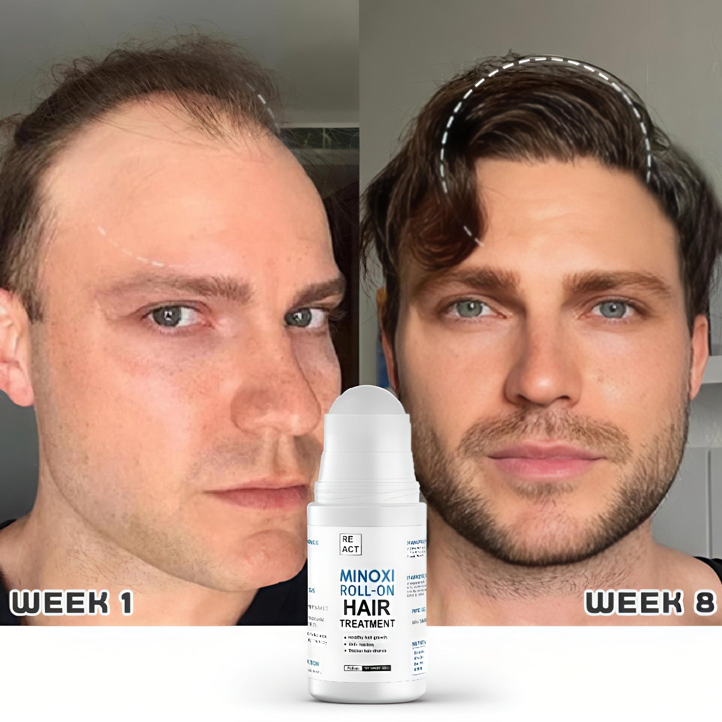 Before and after comparison of a man's hair growth with a Minoxidil roll-on bottle labeled 'Week 1' and 'Week 8'.
