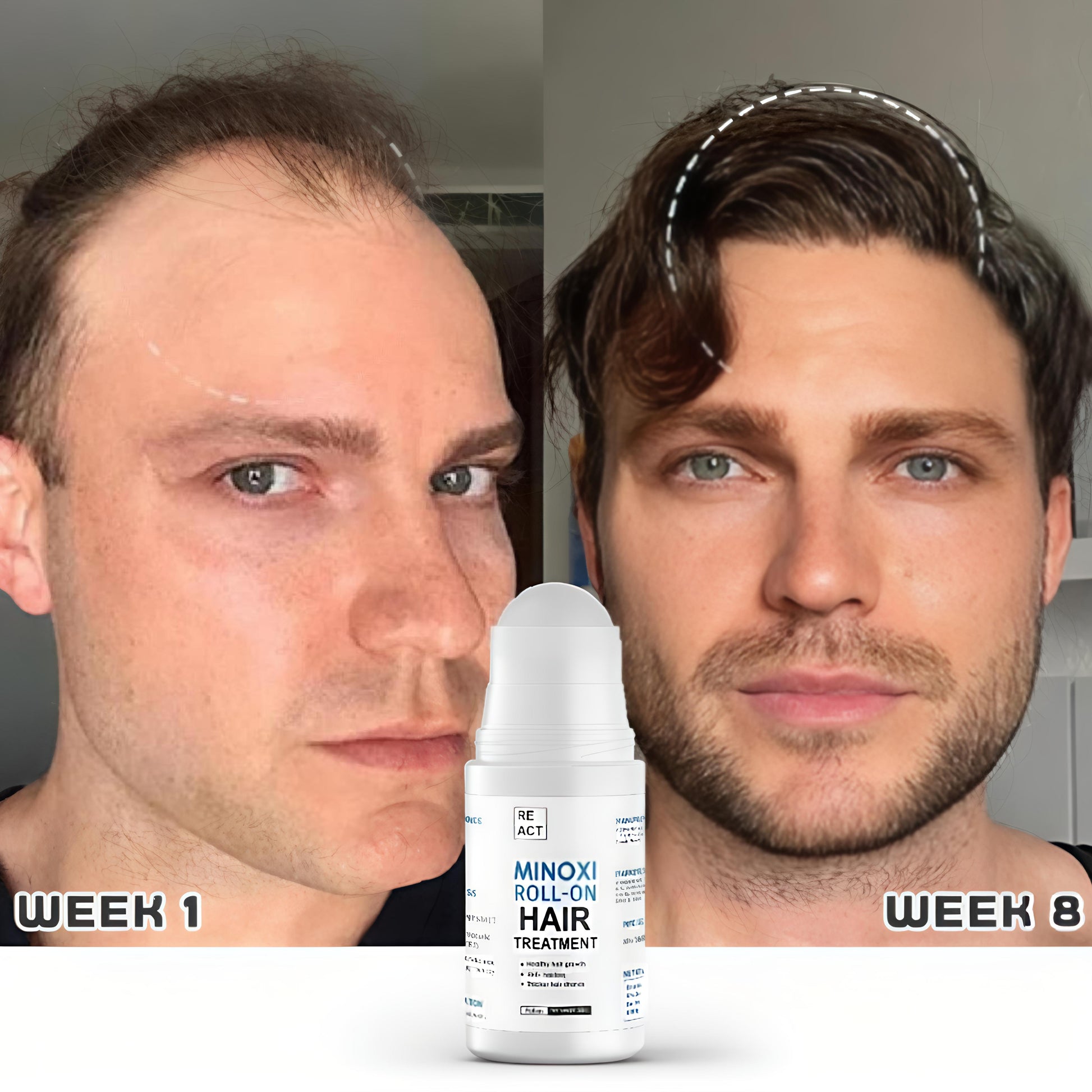 Before and after comparison of a man's hair growth with a Minoxidil roll-on bottle labeled 'Week 1' and 'Week 8'.