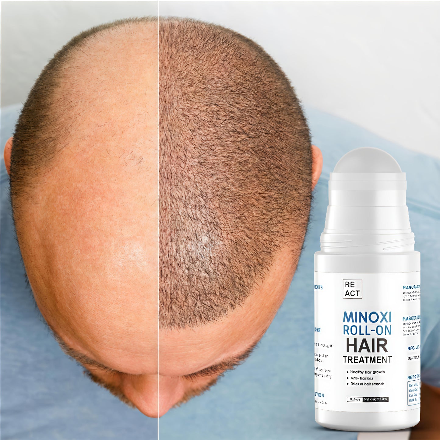 Before and after comparison of a person's head with hair growth, next to a Minoxidil roll-on bottle.